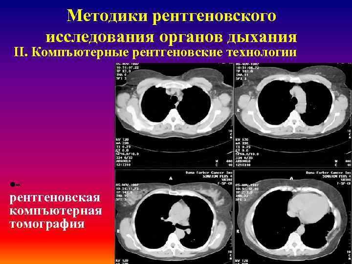 Методики рентгеновского исследования органов дыхания ІІ. Компъютерные рентгеновские технологии ·рентгеновская компъютерная томография 