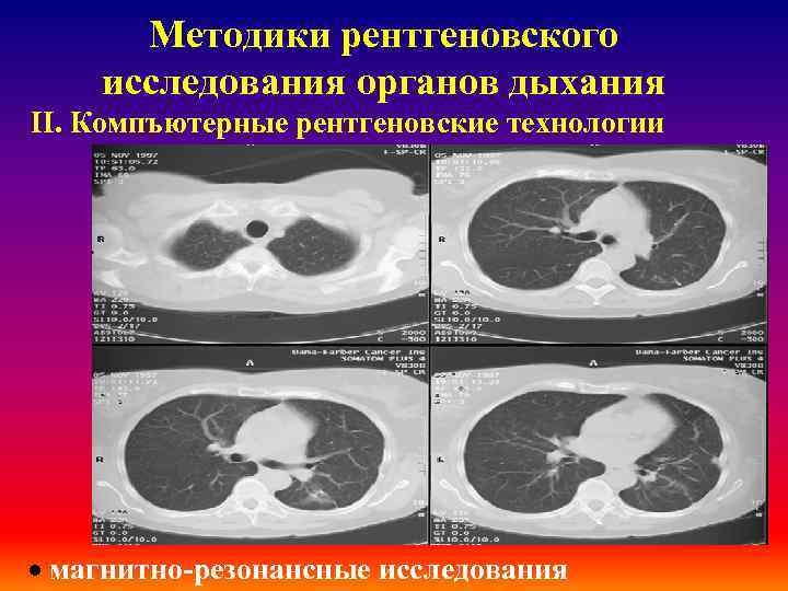 Методики рентгеновского исследования органов дыхания ІІ. Компъютерные рентгеновские технологии · магнитно-резонансные исследования 