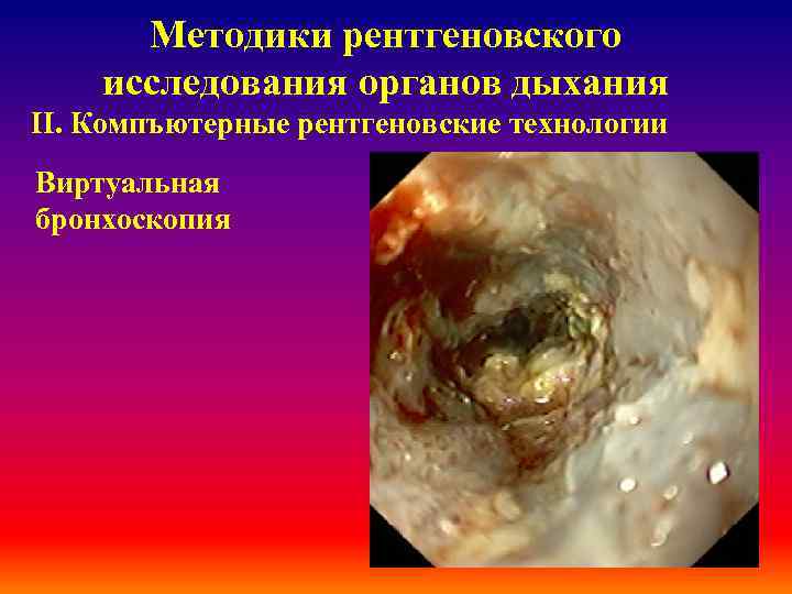Методики рентгеновского исследования органов дыхания ІІ. Компъютерные рентгеновские технологии Виртуальная бронхоскопия 