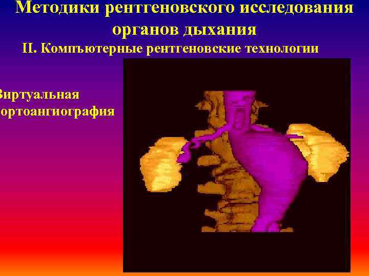 Методики рентгеновского исследования органов дыхания ІІ. Компъютерные рентгеновские технологии Виртуальная аортоангиография 