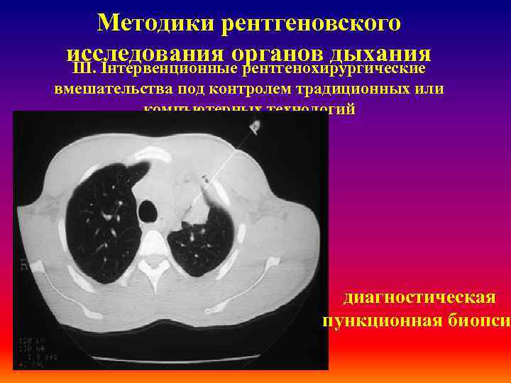 Методики рентгеновского исследования органов дыхания ІІІ. Інтервенционные рентгенохирургические вмешательства под контролем традиционных или компъютерных