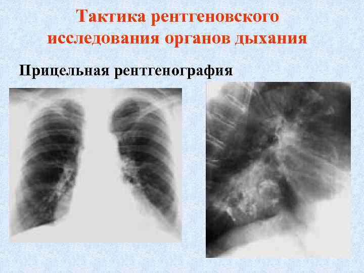 Тактика рентгеновского исследования органов дыхания Прицельная рентгенография 