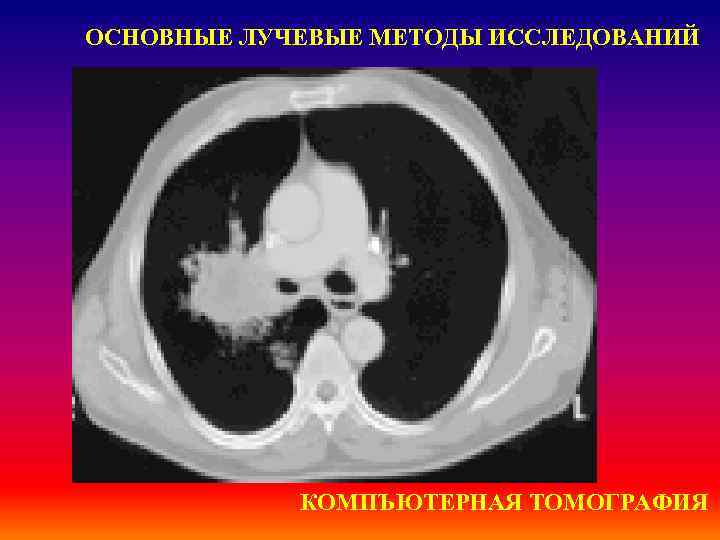 ОСНОВНЫЕ ЛУЧЕВЫЕ МЕТОДЫ ИССЛЕДОВАНИЙ КОМПЪЮТЕРНАЯ ТОМОГРАФИЯ 