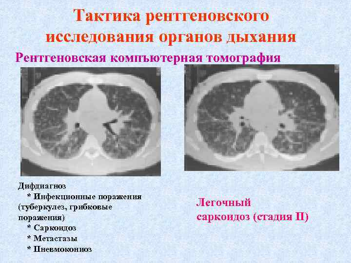 Тактика рентгеновского исследования органов дыхания Рентгеновская компъютерная томография Дифдиагноз * Инфекционные поражения (туберкулез, грибковые