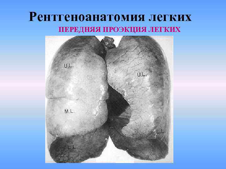 Рентгеноанатомия легких ПЕРЕДНЯЯ ПРОЭКЦИЯ ЛЕГКИХ 