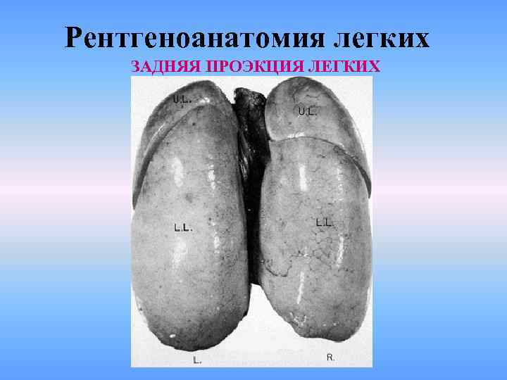 Рентгеноанатомия легких ЗАДНЯЯ ПРОЭКЦИЯ ЛЕГКИХ 
