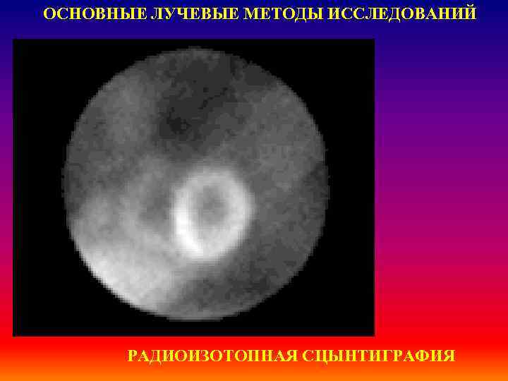 ОСНОВНЫЕ ЛУЧЕВЫЕ МЕТОДЫ ИССЛЕДОВАНИЙ РАДИОИЗОТОПНАЯ СЦЫНТИГРАФИЯ 