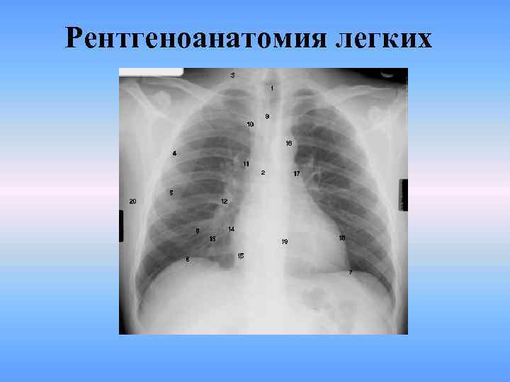 Рентгеноанатомия легких 