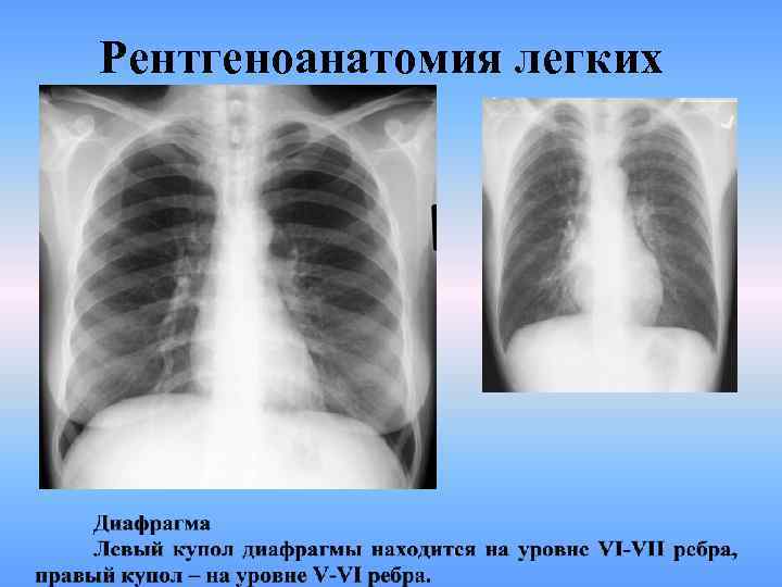 Рентгеноанатомия легких 