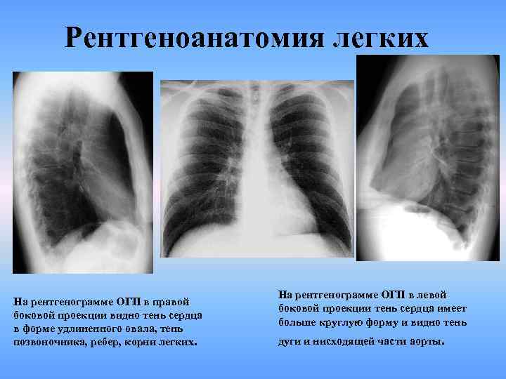 Рентгеноанатомия легких На рентгенограмме ОГП в правой боковой проекции видно тень сердца в форме