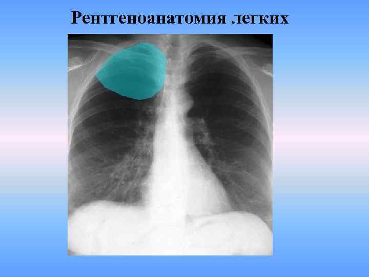 Рентгеноанатомия легких 