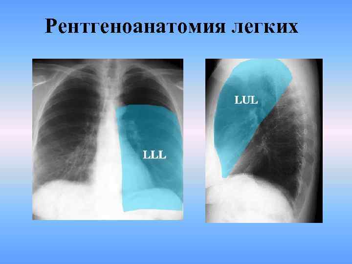 Рентгеноанатомия легких 