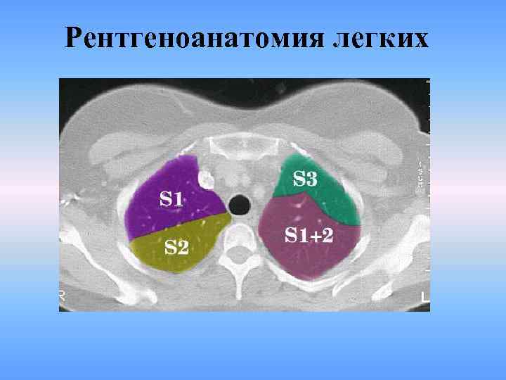 Рентгеноанатомия легких 