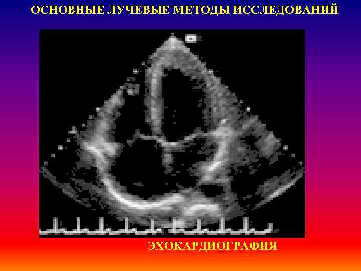 ОСНОВНЫЕ ЛУЧЕВЫЕ МЕТОДЫ ИССЛЕДОВАНИЙ ЭХОКАРДИОГРАФИЯ 