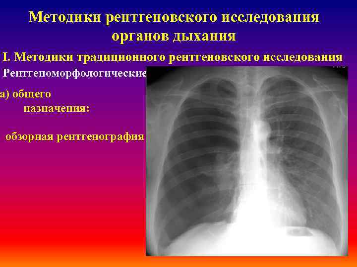 Методики рентгеновского исследования органов дыхания І. Методики традиционного рентгеновского исследования Рентгеноморфологические а) общего назначения: