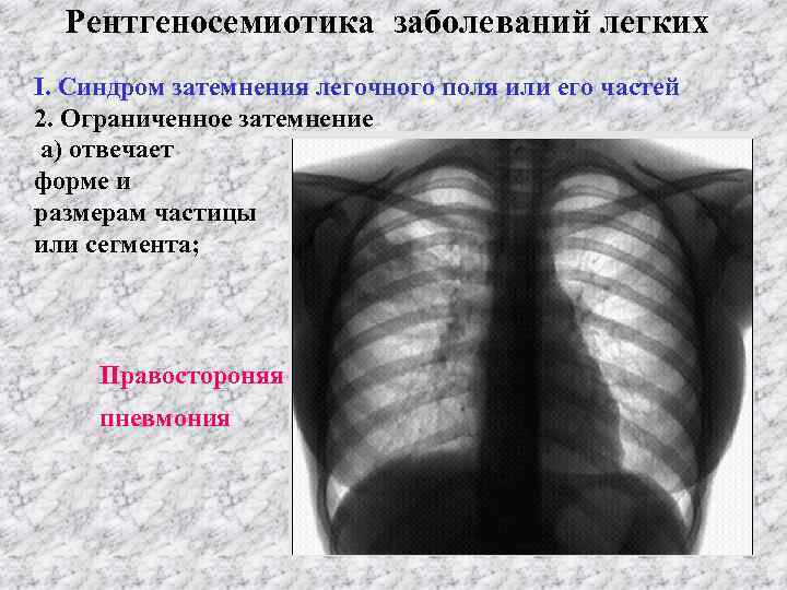 Рентгеносемиотика заболеваний легких І. Синдром затемнения легочного поля или его частей 2. Ограниченное затемнение