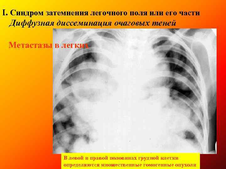 І. Синдром затемнения легочного поля или его части Диффузная диссеминация очаговых теней Метастазы в