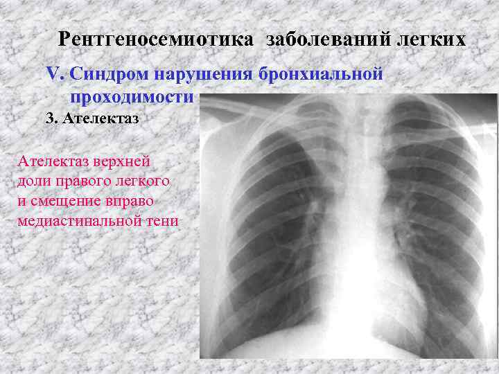 Рентгеносемиотика заболеваний легких V. Синдром нарушения бронхиальной проходимости 3. Ателектаз верхней доли правого легкого