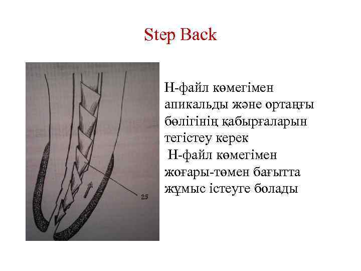 Step Back Н-файл көмегімен апикальды және ортаңғы бөлігінің қабырғаларын тегістеу керек Н-файл көмегімен жоғары-төмен