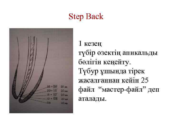 Step Back 1 кезең түбір өзектің апикальды бөлігін кеңейту. Түбур ұшында тірек жасалғаннан кейін