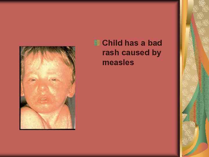 Child has a bad rash caused by measles 