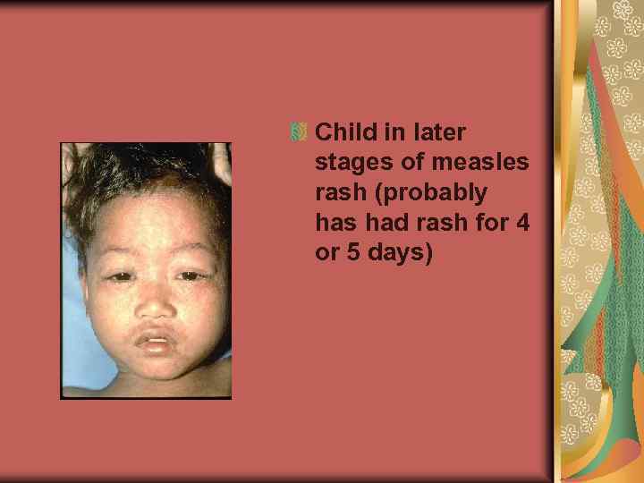 Child in later stages of measles rash (probably has had rash for 4 or