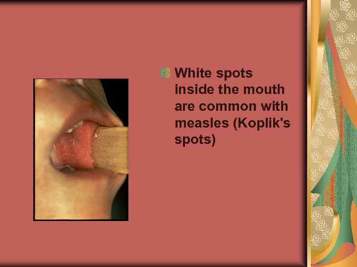 White spots inside the mouth are common with measles (Koplik's spots) 