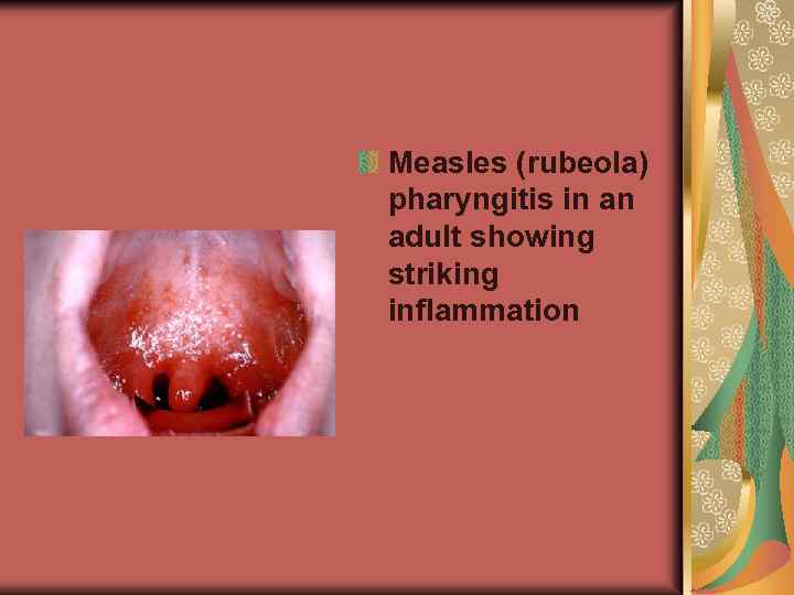 Measles (rubeola) pharyngitis in an adult showing striking inflammation 