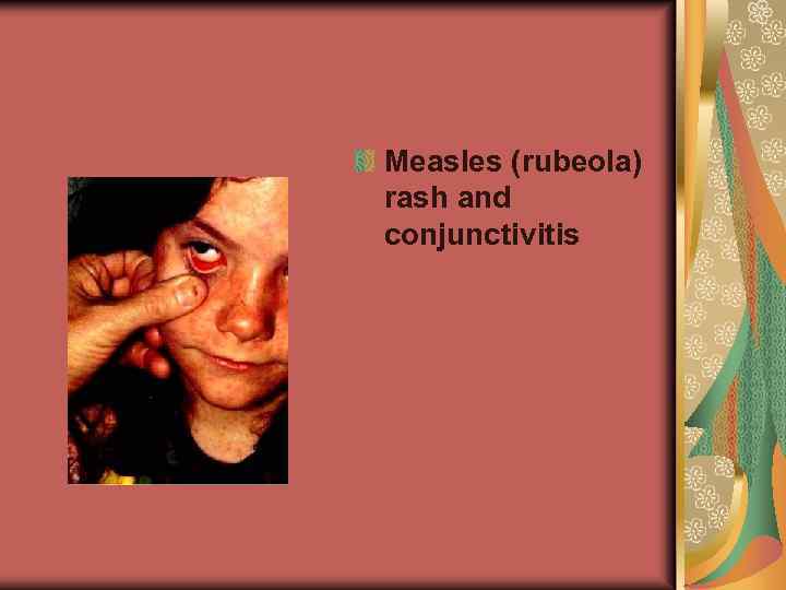 Measles (rubeola) rash and conjunctivitis 