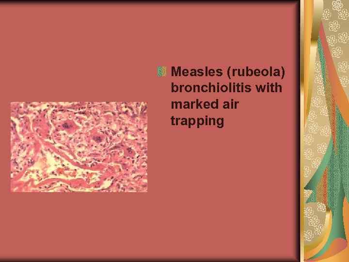 Measles (rubeola) bronchiolitis with marked air trapping 