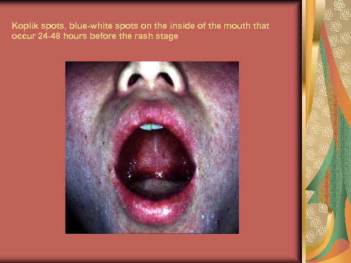 Koplik spots, blue-white spots on the inside of the mouth that occur 24 -48