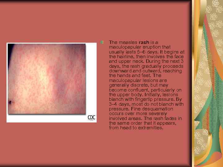 The measles rash is a maculopapular eruption that usually lasts 5– 6 days. It