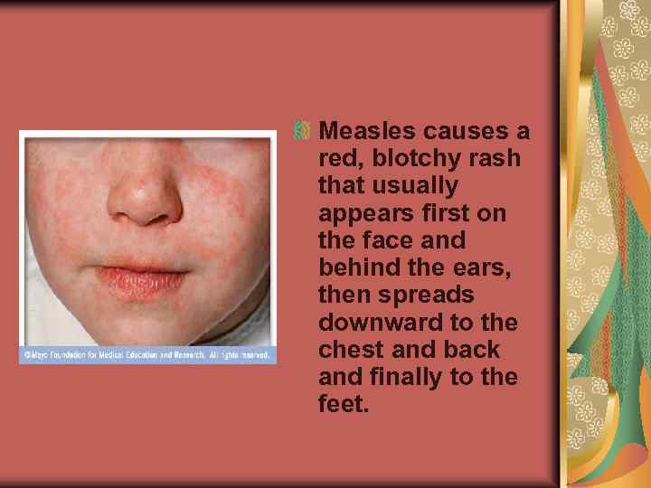 Measles causes a red, blotchy rash that usually appears first on the face and