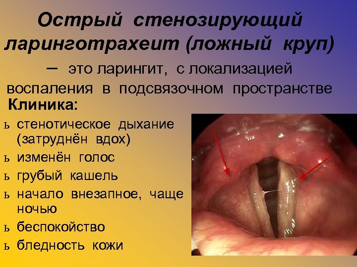 Стенозирующий ларинготрахеит карта вызова