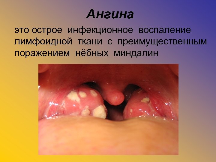 Ангина это острое инфекционное воспаление лимфоидной ткани с преимущественным поражением нёбных миндалин 