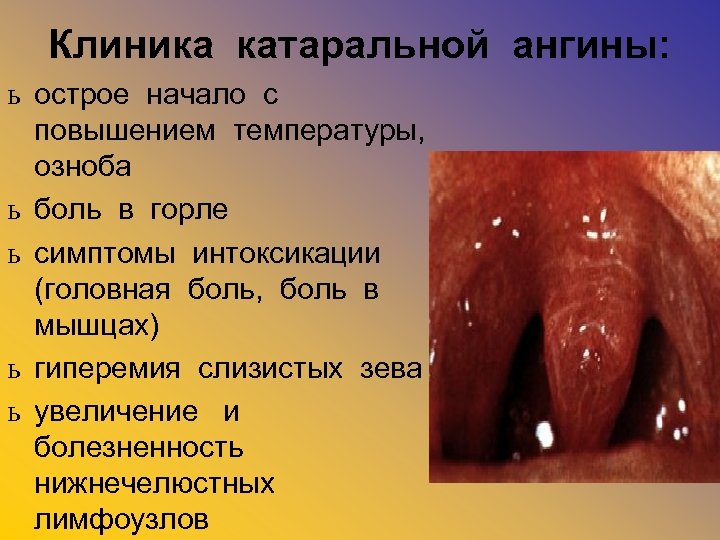 Клиника катаральной ангины: ь острое начало с повышением температуры, озноба ь боль в горле