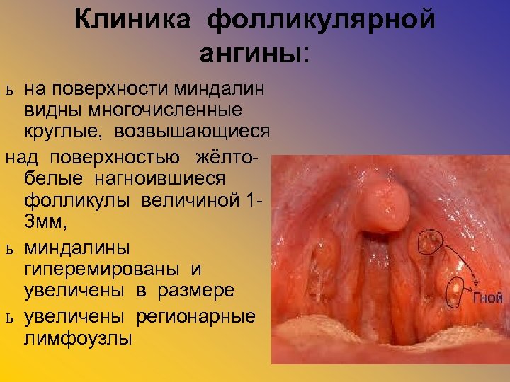 Клиника фолликулярной ангины: ь на поверхности миндалин видны многочисленные круглые, возвышающиеся над поверхностью жёлтобелые
