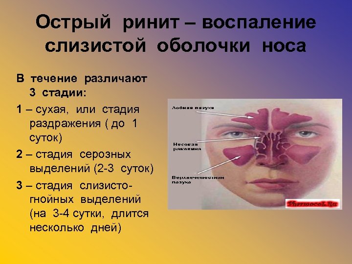 Острый ринит – воспаление слизистой оболочки носа В течение различают 3 стадии: 1 –