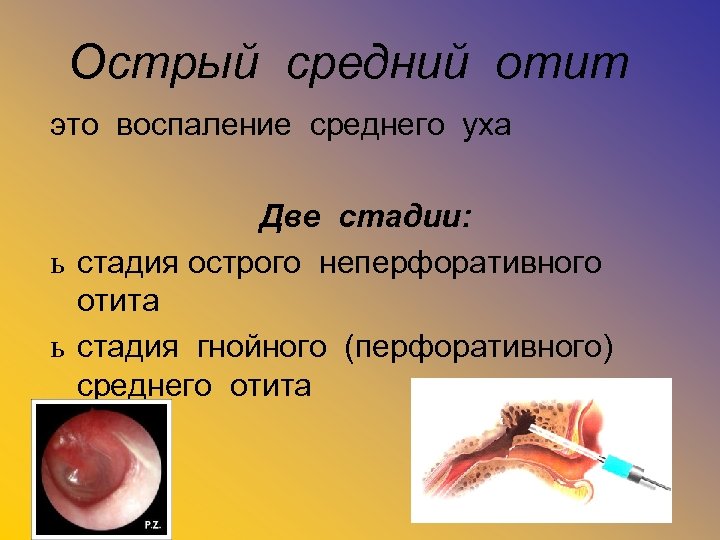 Острый средний отит это воспаление среднего уха Две стадии: ь стадия острого неперфоративного отита