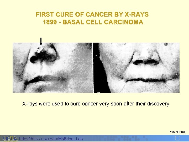 FIRST CURE OF CANCER BY X-RAYS 1899 - BASAL CELL CARCINOMA X-rays were used