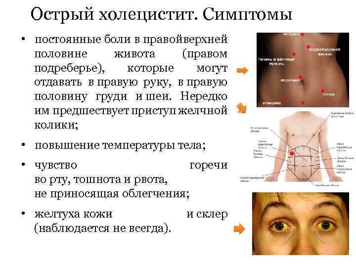 Острый холецистит. Симптомы • постоянные боли в правой ерхней в половине живота (правом подреберье),