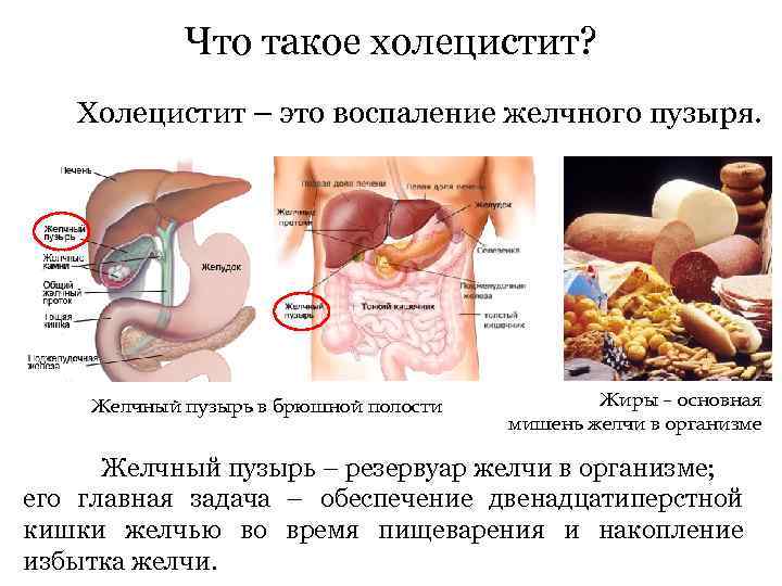 Что такое холецистит? Холецистит – это воспаление желчного пузыря. Желчный пузырь в брюшной полости