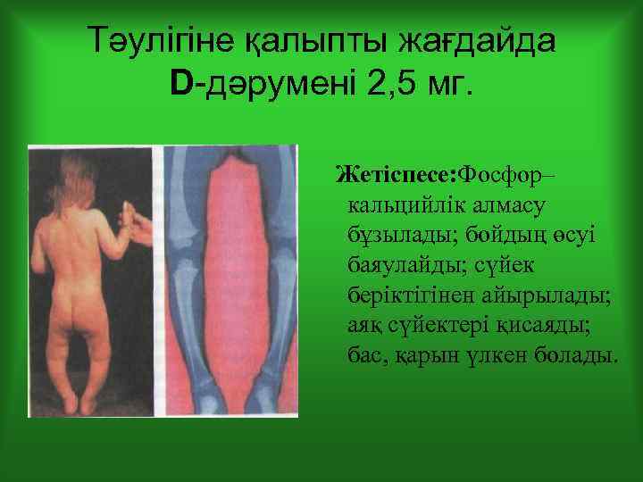 Тәулігіне қалыпты жағдайда D-дәрумені 2, 5 мг. Жетіспесе: Фосфор– кальцийлік алмасу бұзылады; бойдың өсуі