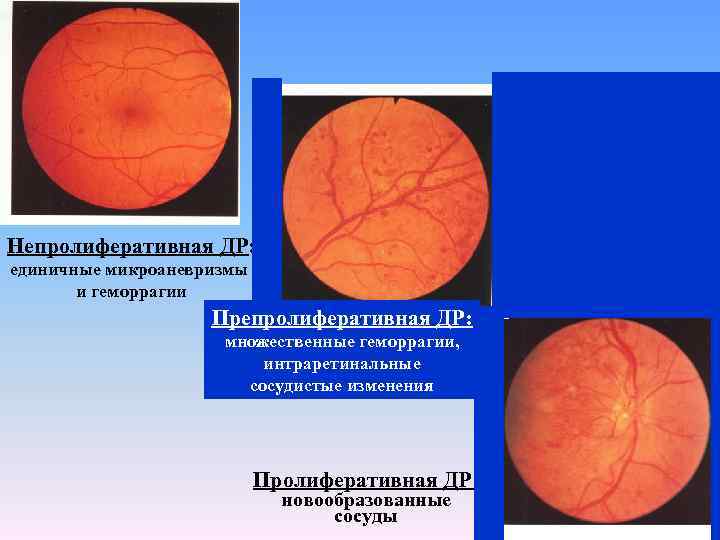 Непролиферативная ДР: единичные микроаневризмы и геморрагии Препролиферативная ДР: множественные геморрагии, интраретинальные сосудистые изменения Пролиферативная