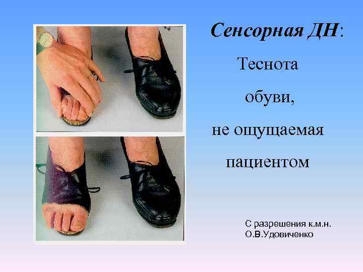 Сенсорная ДН: Теснота обуви, не ощущаемая пациентом С разрешения к. м. н. О. В.