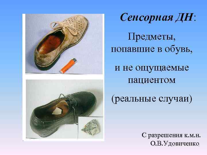 Сенсорная ДН: Предметы, попавшие в обувь, и не ощущаемые пациентом (реальные случаи) С разрешения