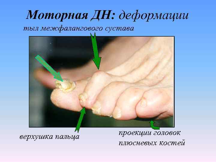 Моторная ДН: деформации тыл межфалангового сустава верхушка пальца проекции головок плюсневых костей 