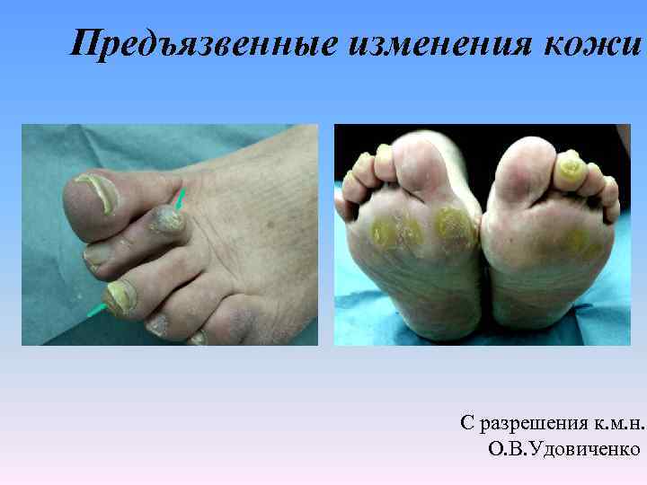 Предъязвенные изменения кожи С разрешения к. м. н. О. В. Удовиченко 