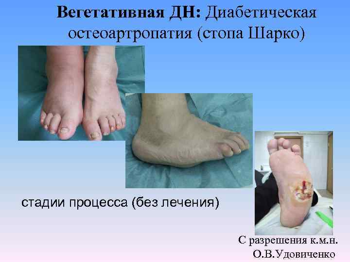 Вегетативная ДН: Диабетическая остеоартропатия (стопа Шарко) стадии процесса (без лечения) С разрешения к. м.