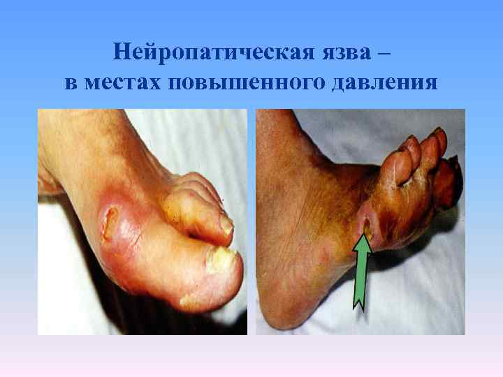 Нейропатическая язва – в местах повышенного давления 